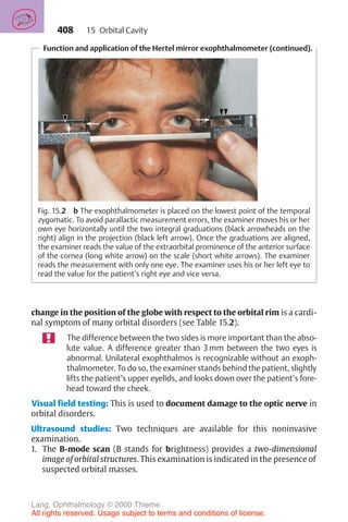 408
Function and application of the Hertel mirror exophthalmometer (continued).
Fig. 15.2 b The exophthalmometer is placed on the lowest point of the temporal
zygomatic. To avoid parallactic measurement errors, the examiner moves his or her
own eye horizontally until the two integral graduations (black arrowheads on the
right) align in the projection (black left arrow). Once the graduations are aligned,
the examiner reads the value of the extraorbital prominence of the anterior surface
of the cornea (long white arrow) on the scale (short white arrows). The examiner
reads the measurement with only one eye. The examiner uses his or her left eye to
read the value for the patient’s right eye and vice versa.
change in the position of the globe with respect to the orbital rim is a cardi-
nal symptom of many orbital disorders (see Table 15.2).
The difference between the two sides is more important than the abso-
lute value. A difference greater than 3 mm between the two eyes is
abnormal. Unilateral exophthalmos is recognizable without an exoph-
thalmometer. To do so, the examiner stands behind the patient, slightly
lifts the patient’s upper eyelids, and looks down over the patient’s fore-
head toward the cheek.
Visual field testing: This is used to document damage to the optic nerve in
orbital disorders.
Ultrasound studies: Two techniques are available for this noninvasive
examination.
1. The B-mode scan (B stands for brightness) provides a two-dimensional
image of orbital structures. This examination is indicated in the presence of
suspected orbital masses.
15 Orbital Cavity
Lang, Ophthalmology © 2000 Thieme
All rights reserved. Usage subject to terms and conditions of license.
 