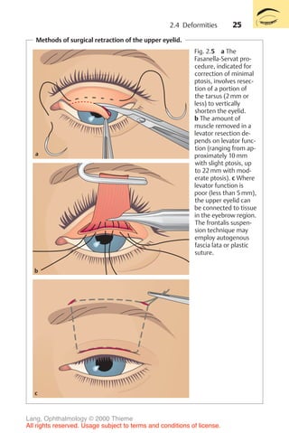 25
Methods of surgical retraction of the upper eyelid.
c
b
a
Fig. 2.5 a The
Fasanella-Servat pro-
cedure, indicated for
correction of minimal
ptosis, involves resec-
tion of a portion of
the tarsus (2 mm or
less) to vertically
shorten the eyelid.
b The amount of
muscle removed in a
levator resection de-
pends on levator func-
tion (ranging from ap-
proximately 10 mm
with slight ptosis, up
to 22 mm with mod-
erate ptosis). c Where
levator function is
poor (less than 5 mm),
the upper eyelid can
be connected to tissue
in the eyebrow region.
The frontalis suspen-
sion technique may
employ autogenous
fascia lata or plastic
suture.
2.4 Deformities
Lang, Ophthalmology © 2000 Thieme
All rights reserved. Usage subject to terms and conditions of license.
 