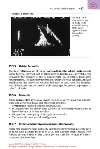 417
15.5.5 Orbital Periostitis
This is an inflammation of the periosteum lining the orbital cavity, usually
due to bacterial infection such as actinomycosis, tuberculosis, or syphilis. Less
frequently, the disorder is due to osteomyelitis or, in infants, tooth germ
inflammations. The clinical symptoms are similar to orbital cellulitis although
significantly less severe and without limitation of ocular motility. Liquefac-
tion of the process creates an orbital abscess; large abscesses may progress to
orbital cellulitis.
15.5.6 Mucocele
These mucus-filled cysts may invade the orbital cavity in chronic sinusitis.
They displace orbital tissue and cause exophthalmos.
Treatment is required in the following cases:
❖ Displacement of the globe causes cosmetic or functional problems, such as
lagophthalmos or limited motility.
❖ Compression neuropathy of the optic nerve results.
❖ The mucocele becomes infected (pyocele).
15.5.7 Mycoses (Mucormycosis and Aspergillomycosis)
These rare disorders occur primarily in immunocompromised patients, such
as those with diabetes mellitus or AIDS. The disorder often spreads from
infected paranasal sinuses. The clinical picture is similar to those of inflam-
matory orbital disorders.
Diagnosis of myositis.
Fig. 15.6 The
ultrasound image
(B-mode scan)
shows thickening
of the entire
hypoechoic rec-
tus medialis
(arrow).
15.5 Orbital Inflammation
Lang, Ophthalmology © 2000 Thieme
All rights reserved. Usage subject to terms and conditions of license.
 