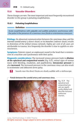 418
15.6 Vascular Disorders
These changes are rare. The most important and most frequently encountered
disorder in this group is pulsating exophthalmos.
15.6.1 Pulsating Exophthalmos
Definition
Acute exophthalmos with palpable and audible pulsations synchronous with
the pulse in the presence of a cavernous sinus fistula or arteriovenous aneurysm.
Etiology: An abnormal communication between the cavernous sinus and the
internal carotid artery (a direct shunt) or its branches (indirect shunt) results
in distention of the orbital venous network. Eighty per cent of all cases are
attributable to trauma; less frequently the disorder is due to syphilis or arte-
riosclerosis.
Symptoms: Patients report an unpleasant sound in the head that is reminis-
cent of a machine and synchronous with their pulse.
Diagnostic considerations: The increased venous pressure leads to dilation
of the episcleral and conjunctival vessels (Fig. 15.7), retinal signs of venous
stasis with bleeding, exudation, and papilledema. Intraocular pressure is
also increased. The increased pressure in the cavernous sinus can also result
in oculomotor and abducent nerve palsy.
Sounds near the direct fistula are clearly audible with a stethoscope.
Fistula between the carotid artery and cavernous sinus.
Fig. 15.7 The
episcleral and
conjunctival ves-
sels are signifi-
cantly dilated and
describe tortuous
corkscrew
courses.
15 Orbital Cavity
Lang, Ophthalmology © 2000 Thieme
All rights reserved. Usage subject to terms and conditions of license.
 