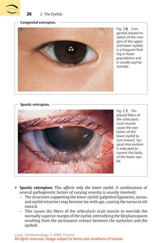 26
Congenital entropion.
Fig. 2.6 Con-
genital inward ro-
tation of the mar-
gins of the upper
and lower eyelids
is a frequent find-
ing in Asian
populations and
is usually asymp-
tomatic.
Spastic entropion.
Fig. 2.7 Dis-
placed fibers of
the orbicularis
oculi muscle
cause the eye-
lashes of the
lower eyelid to
turn inward. Sur-
gical intervention
is indicated to
correct the laxity
of the lower eye-
lid.
❖ Spastic entropion: This affects only the lower eyelid. A combination of
several pathogenetic factors of varying severity is usually involved:
– The structures supporting the lower eyelid (palpebral ligaments, tarsus,
and eyelid retractor) may become lax with age, causing the tarsus to tilt
inward.
– This causes the fibers of the orbicularis oculi muscle to override the
normally superior margin of the eyelid, intensifying the blepharospasm
resulting from the permanent contact between the eyelashes and the
eyeball.
2 The Eyelids
Lang, Ophthalmology © 2000 Thieme
All rights reserved. Usage subject to terms and conditions of license.
 