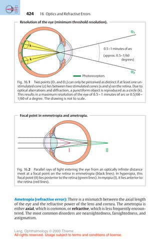 424
k
k
0.5–1minutes of arc
(approx. 0.5–1/60
degrees)
Photoreceptors
O1
O2
k
k
y
x
z
Resolution of the eye (minimum threshold resolution).
Fig. 16.1 Two points (O1 and O2) can only be perceived as distinct if at least one un-
stimulated cone (z) lies between two stimulated cones (x and y) on the retina. Due to
optical aberrations and diffraction, a punctiform object is reproduced as a circle (k).
This results in a maximum resolution of the eye of 0.5–1 minutes of arc or 0.5/60–
1/60 of a degree. The drawing is not to scale.
Focal point in emmetropia and ametropia.
Fig. 16.2 Parallel rays of light entering the eye from an optically infinite distance
meet at a focal point on the retina in emmetropia (black lines). In hyperopia, this
focal point (II) lies posterior to the retina (green lines). In myopia (I), it lies anterior to
the retina (red lines).
Ametropia (refractive error): There is a mismatch between the axial length
of the eye and the refractive power of the lens and cornea. The ametropia is
either axial, which is common, or refractive, which is less frequently encoun-
tered. The most common disorders are nearsightedness, farsightedness, and
astigmatism.
16 Optics and Refractive Errors
Lang, Ophthalmology © 2000 Thieme
All rights reserved. Usage subject to terms and conditions of license.
 