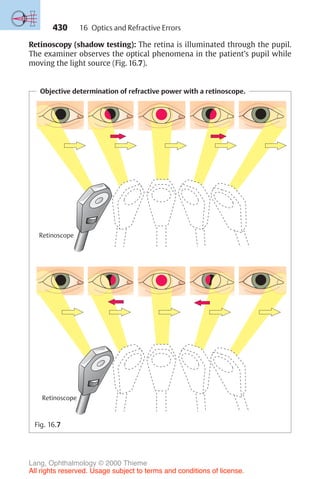 430
Retinoscopy (shadow testing): The retina is illuminated through the pupil.
The examiner observes the optical phenomena in the patient’s pupil while
moving the light source (Fig. 16.7).
Objective determination of refractive power with a retinoscope.
Retinoscope
Retinoscope
Fig. 16.7
16 Optics and Refractive Errors
Lang, Ophthalmology © 2000 Thieme
All rights reserved. Usage subject to terms and conditions of license.
 