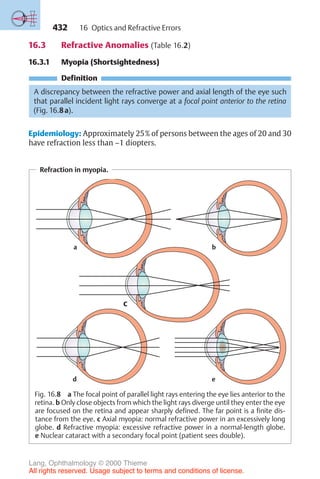 432
16.3 Refractive Anomalies (Table 16.2)
16.3.1 Myopia (Shortsightedness)
Definition
A discrepancy between the refractive power and axial length of the eye such
that parallel incident light rays converge at a focal point anterior to the retina
(Fig. 16.8a).
Epidemiology: Approximately 25% of persons between the ages of 20 and 30
have refraction less than –1 diopters.
Refraction in myopia.
b
a
e
c
d
Fig. 16.8 a The focal point of parallel light rays entering the eye lies anterior to the
retina. b Only close objects from which the light rays diverge until they enter the eye
are focused on the retina and appear sharply defined. The far point is a finite dis-
tance from the eye. c Axial myopia: normal refractive power in an excessively long
globe. d Refractive myopia: excessive refractive power in a normal-length globe.
e Nuclear cataract with a secondary focal point (patient sees double).
16 Optics and Refractive Errors
Lang, Ophthalmology © 2000 Thieme
All rights reserved. Usage subject to terms and conditions of license.
 