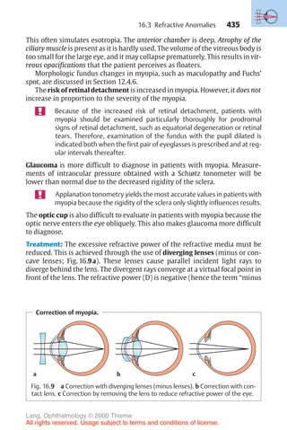 435
Correction of myopia.
a b c
Fig. 16.9 a Correction with diverging lenses (minus lenses). b Correction with con-
tact lens. c Correction by removing the lens to reduce refractive power of the eye.
This often simulates esotropia. The anterior chamber is deep. Atrophy of the
ciliary muscle is present as it is hardly used. The volume of the vitreous body is
too small for the large eye, and it may collapse prematurely. This results in vit-
reous opacifications that the patient perceives as floaters.
Morphologic fundus changes in myopia, such as maculopathy and Fuchs’
spot, are discussed in Section 12.4.6.
The risk of retinal detachment is increased in myopia. However, it does not
increase in proportion to the severity of the myopia.
Because of the increased risk of retinal detachment, patients with
myopia should be examined particularly thoroughly for prodromal
signs of retinal detachment, such as equatorial degeneration or retinal
tears. Therefore, examination of the fundus with the pupil dilated is
indicated both when the first pair of eyeglasses is prescribed and at reg-
ular intervals thereafter.
Glaucoma is more difficult to diagnose in patients with myopia. Measure-
ments of intraocular pressure obtained with a Schiøtz tonometer will be
lower than normal due to the decreased rigidity of the sclera.
Applanation tonometry yields the most accurate values in patients with
myopia because the rigidity of the sclera only slightly influences results.
The optic cup is also difficult to evaluate in patients with myopia because the
optic nerve enters the eye obliquely. This also makes glaucoma more difficult
to diagnose.
Treatment: The excessive refractive power of the refractive media must be
reduced. This is achieved through the use of diverging lenses (minus or con-
cave lenses; Fig. 16.9a). These lenses cause parallel incident light rays to
diverge behind the lens. The divergent rays converge at a virtual focal point in
front of the lens. The refractive power (D) is negative (hence the term “minus
16.3 Refractive Anomalies
Lang, Ophthalmology © 2000 Thieme
All rights reserved. Usage subject to terms and conditions of license.
 