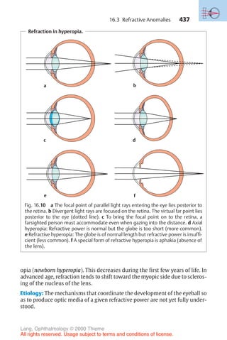 437
opia (newborn hyperopia). This decreases during the first few years of life. In
advanced age, refraction tends to shift toward the myopic side due to scleros-
ing of the nucleus of the lens.
Etiology: The mechanisms that coordinate the development of the eyeball so
as to produce optic media of a given refractive power are not yet fully under-
stood.
Refraction in hyperopia.
a b
d
e f
c
Fig. 16.10 a The focal point of parallel light rays entering the eye lies posterior to
the retina. b Divergent light rays are focused on the retina. The virtual far point lies
posterior to the eye (dotted line). c To bring the focal point on to the retina, a
farsighted person must accommodate even when gazing into the distance. d Axial
hyperopia: Refractive power is normal but the globe is too short (more common).
e Refractive hyperopia: The globe is of normal length but refractive power is insuffi-
cient (less common). f A special form of refractive hyperopia is aphakia (absence of
the lens).
16.3 Refractive Anomalies
Lang, Ophthalmology © 2000 Thieme
All rights reserved. Usage subject to terms and conditions of license.
 