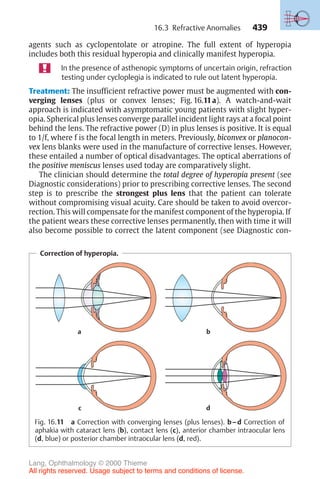 439
agents such as cyclopentolate or atropine. The full extent of hyperopia
includes both this residual hyperopia and clinically manifest hyperopia.
In the presence of asthenopic symptoms of uncertain origin, refraction
testing under cycloplegia is indicated to rule out latent hyperopia.
Treatment: The insufficient refractive power must be augmented with con-
verging lenses (plus or convex lenses; Fig. 16.11a). A watch-and-wait
approach is indicated with asymptomatic young patients with slight hyper-
opia. Spherical plus lenses converge parallel incident light rays at a focal point
behind the lens. The refractive power (D) in plus lenses is positive. It is equal
to 1/f, where f is the focal length in meters. Previously, biconvex or planocon-
vex lens blanks were used in the manufacture of corrective lenses. However,
these entailed a number of optical disadvantages. The optical aberrations of
the positive meniscus lenses used today are comparatively slight.
The clinician should determine the total degree of hyperopia present (see
Diagnostic considerations) prior to prescribing corrective lenses. The second
step is to prescribe the strongest plus lens that the patient can tolerate
without compromising visual acuity. Care should be taken to avoid overcor-
rection. This will compensate for the manifest component of the hyperopia. If
the patient wears these corrective lenses permanently, then with time it will
also become possible to correct the latent component (see Diagnostic con-
Correction of hyperopia.
a b
d
c
Fig. 16.11 a Correction with converging lenses (plus lenses). b–d Correction of
aphakia with cataract lens (b), contact lens (c), anterior chamber intraocular lens
(d, blue) or posterior chamber intraocular lens (d, red).
16.3 Refractive Anomalies
Lang, Ophthalmology © 2000 Thieme
All rights reserved. Usage subject to terms and conditions of license.
 
