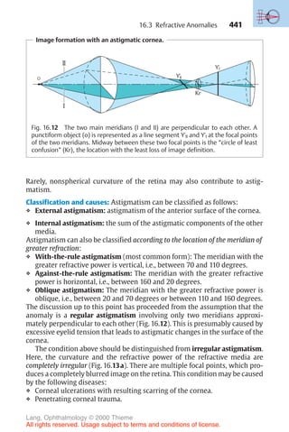 441
Rarely, nonspherical curvature of the retina may also contribute to astig-
matism.
Classification and causes: Astigmatism can be classified as follows:
❖ External astigmatism: astigmatism of the anterior surface of the cornea.
❖ Internal astigmatism: the sum of the astigmatic components of the other
media.
Astigmatism can also be classified according to the location of the meridian of
greater refraction:
❖ With-the-rule astigmatism (most common form): The meridian with the
greater refractive power is vertical, i.e., between 70 and 110 degrees.
❖ Against-the-rule astigmatism: The meridian with the greater refractive
power is horizontal, i.e., between 160 and 20 degrees.
❖ Oblique astigmatism: The meridian with the greater refractive power is
oblique, i.e., between 20 and 70 degrees or between 110 and 160 degrees.
The discussion up to this point has proceeded from the assumption that the
anomaly is a regular astigmatism involving only two meridians approxi-
mately perpendicular to each other (Fig. 16.12). This is presumably caused by
excessive eyelid tension that leads to astigmatic changes in the surface of the
cornea.
The condition above should be distinguished from irregular astigmatism.
Here, the curvature and the refractive power of the refractive media are
completely irregular (Fig. 16.13a). There are multiple focal points, which pro-
duces a completely blurred image on the retina. This condition may be caused
by the following diseases:
❖ Corneal ulcerations with resulting scarring of the cornea.
❖ Penetrating corneal trauma.
Image formation with an astigmatic cornea.
Y'
Y'
Kr
Fig. 16.12 The two main meridians (I and II) are perpendicular to each other. A
punctiform object (o) is represented as a line segment Y'II and Y'I at the focal points
of the two meridians. Midway between these two focal points is the “circle of least
confusion” (Kr), the location with the least loss of image definition.
16.3 Refractive Anomalies
Lang, Ophthalmology © 2000 Thieme
All rights reserved. Usage subject to terms and conditions of license.
 