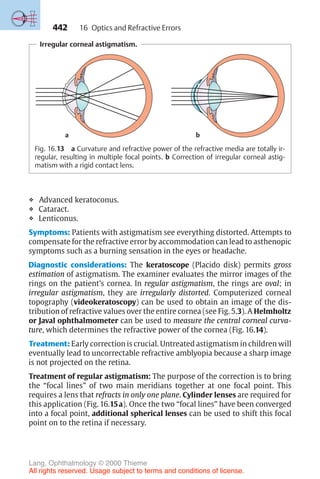 442
❖ Advanced keratoconus.
❖ Cataract.
❖ Lenticonus.
Symptoms: Patients with astigmatism see everything distorted. Attempts to
compensate for the refractive error by accommodation can lead to asthenopic
symptoms such as a burning sensation in the eyes or headache.
Diagnostic considerations: The keratoscope (Placido disk) permits gross
estimation of astigmatism. The examiner evaluates the mirror images of the
rings on the patient’s cornea. In regular astigmatism, the rings are oval; in
irregular astigmatism, they are irregularly distorted. Computerized corneal
topography (videokeratoscopy) can be used to obtain an image of the dis-
tribution of refractive values over the entire cornea (see Fig. 5.3). A Helmholtz
or Javal ophthalmometer can be used to measure the central corneal curva-
ture, which determines the refractive power of the cornea (Fig. 16.14).
Treatment: Early correction is crucial. Untreated astigmatism in children will
eventually lead to uncorrectable refractive amblyopia because a sharp image
is not projected on the retina.
Treatment of regular astigmatism: The purpose of the correction is to bring
the “focal lines” of two main meridians together at one focal point. This
requires a lens that refracts in only one plane. Cylinder lenses are required for
this application (Fig. 16.15a). Once the two “focal lines” have been converged
into a focal point, additional spherical lenses can be used to shift this focal
point on to the retina if necessary.
Irregular corneal astigmatism.
b
a
b
a
Fig. 16.13 a Curvature and refractive power of the refractive media are totally ir-
regular, resulting in multiple focal points. b Correction of irregular corneal astig-
matism with a rigid contact lens.
16 Optics and Refractive Errors
Lang, Ophthalmology © 2000 Thieme
All rights reserved. Usage subject to terms and conditions of license.
 
