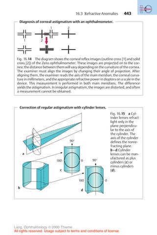 443
Diagnosis of corneal astigmatism with an ophthalmometer.
1 2
1 2
Fig. 16.14 The diagram shows the corneal reflex images (outline cross [1] and solid
cross [2]) of the Zeiss ophthalmometer. These images are projected on to the cor-
nea; the distance between them will vary depending on the curvature of the cornea.
The examiner must align the images by changing their angle of projection. After
aligning them, the examiner reads the axis of the main meridian, the corneal curva-
ture in millimeters, and the appropriate refractive power in diopters on a scale in the
device. This measurement is performed in both main meridians. The difference
yields the astigmatism. In irregular astigmatism, the images are distorted, and often
a measurement cannot be obtained.
Correction of regular astigmatism with cylinder lenses.
0
0
90°
90°
180
180
a
b
c
d
Fig. 16.15 a Cyl-
inder lenses refract
light only in the
plane perpendicu-
lar to the axis of
the cylinder. The
axis of the cylinder
defines the nonre-
fracting plane.
b–d Cylinder
lenses can be man-
ufactured as plus
cylinders (c) or
minus cylinders
(d).
16.3 Refractive Anomalies
Lang, Ophthalmology © 2000 Thieme
All rights reserved. Usage subject to terms and conditions of license.
 