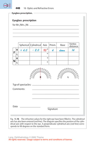 448
Eyeglass prescription.
R
Eyeglass prescription
for Mr./Mrs./M.
Spherical Axis Prism. Base Vertex
distance
R
L
R
L
F
N
Typ of spectacles:
:
Comments:
Date
Signature
180
17
0
1
6
0
1
5
0
1
4
0
130120 110 100 90 80 70 60
50
4
0
3
0
2
0
10
0
R
180
17
0
1
6
0
1
5
0
1
4
0
130120 110 100 90 80 70 60
50
4
0
3
0
2
0
10
0
L
Cylindrical
Fig. 16.16 The refraction values for the right eye have been filled in. The cylindrical
axis has also been entered (red line). The diagram specifies the position of the cylin-
drical axis with respect to the eye. A perpendicular cylindrical axis (red line) corre-
sponds to 90 degrees on the standard form.
16 Optics and Refractive Errors
Lang, Ophthalmology © 2000 Thieme
All rights reserved. Usage subject to terms and conditions of license.
 