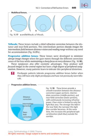 449
Multifocal lenses.
a b c
Fig. 16.17 a and b Bifocals. c Trifocals.
Trifocals: These lenses include a third refractive correction between the dis-
tance and near-field portions. This intermediate portion sharply images the
intermediate field between distance vision and reading range without any need
for accommodation (Fig. 16.17c).
Progressive addition lenses: These lenses were developed to minimize
abrupt image changes when the gaze moves through the different correction
zones of the lens while maintaining a sharp focus at every distance (Fig. 16.18).
These eyeglasses also offer cosmetic advantages. They produce well
focused images in the central region but have a high degree of peripheral astig-
matism. However, many patients learn to tolerate this peripheral distortion.
Presbyopic patients tolerate progressive addition lenses better when
they still have only slight presbyopia and have not previously worn bifo-
cals.
Progressive addition lenses.
Distance
correction
Intermediate
correction
Near-
field
correction
Fig. 16.18 These lenses provide a
smooth transition between the distance
correction (upper portion), interme-
diate correction (middle portion), and
near-field correction (lower portion),
with continuously increasing refractive
power. Clear vision is limited to only the
light blue area. The stronger the Add in
the near field, the narrower this light
blue corridor becomes. At the same
time, this increases the peripheral opti-
cal distortion (dark blue) outside the
corridor.
16.5 Correction of Refractive Errors
Lang, Ophthalmology © 2000 Thieme
All rights reserved. Usage subject to terms and conditions of license.
 