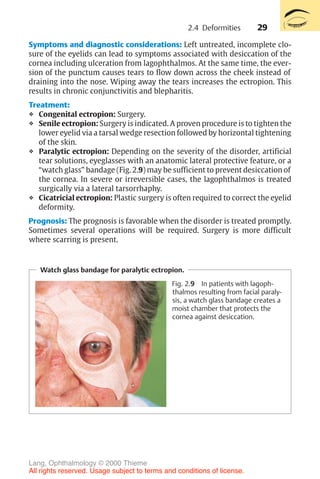 29
Symptoms and diagnostic considerations: Left untreated, incomplete clo-
sure of the eyelids can lead to symptoms associated with desiccation of the
cornea including ulceration from lagophthalmos. At the same time, the ever-
sion of the punctum causes tears to flow down across the cheek instead of
draining into the nose. Wiping away the tears increases the ectropion. This
results in chronic conjunctivitis and blepharitis.
Treatment:
❖ Congenital ectropion: Surgery.
❖ Senile ectropion: Surgery is indicated. A proven procedure is to tighten the
lower eyelid via a tarsal wedge resection followed by horizontal tightening
of the skin.
❖ Paralytic ectropion: Depending on the severity of the disorder, artificial
tear solutions, eyeglasses with an anatomic lateral protective feature, or a
“watch glass” bandage (Fig. 2.9) may be sufficient to prevent desiccation of
the cornea. In severe or irreversible cases, the lagophthalmos is treated
surgically via a lateral tarsorrhaphy.
❖ Cicatricial ectropion: Plastic surgery is often required to correct the eyelid
deformity.
Prognosis: The prognosis is favorable when the disorder is treated promptly.
Sometimes several operations will be required. Surgery is more difficult
where scarring is present.
Watch glass bandage for paralytic ectropion.
Fig. 2.9 In patients with lagoph-
thalmos resulting from facial paraly-
sis, a watch glass bandage creates a
moist chamber that protects the
cornea against desiccation.
2.4 Deformities
Lang, Ophthalmology © 2000 Thieme
All rights reserved. Usage subject to terms and conditions of license.
 