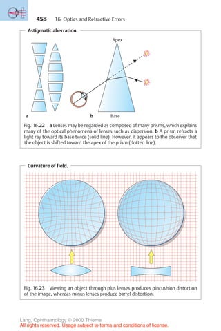458
Astigmatic aberration.
Apex
a b Base
Fig. 16.22 a Lenses may be regarded as composed of many prisms, which explains
many of the optical phenomena of lenses such as dispersion. b A prism refracts a
light ray toward its base twice (solid line). However, it appears to the observer that
the object is shifted toward the apex of the prism (dotted line).
Curvature of field.
Fig. 16.23 Viewing an object through plus lenses produces pincushion distortion
of the image, whereas minus lenses produce barrel distortion.
16 Optics and Refractive Errors
Lang, Ophthalmology © 2000 Thieme
All rights reserved. Usage subject to terms and conditions of license.
 