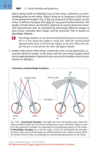 464
object always lands on identical areas of the retina, referred to as corre-
sponding points on the retina. Objects lying on an imaginary circle known
as the geometric horopter (Fig. 17.3a) are projected to these points on the
retina. A different horopter will apply for any given fixation distance. The
images of both retinas are therefore identical in normal binocular vision.
This phenomenon may be examined by presenting different images to
each retina; normally both images will be perceived. This is known as
physiologic diplopia.
Physiologic diplopia can be demonstrated by placing two vertical pen-
cils in a line along the subject’s visual axis, with the second pencil
approximately twice as far from the subject as the first. When the sub-
ject focuses on one pencil, the other will appear double.
2. Fusion: Only where both retinas convey the same visual impression, i.e.,
transmit identical images to the brain, will the two retinal images blend
into a single perception. Impaired fusion can result in double vision (horror
fusionis or diplopia).
Geometric and physiologic horopters.
Panum's area
a b
A
B
Fixation point
Fovea Fovea
Horopter
Fovea Fovea
Fixation point
A
B
Fig. 17.3 a Geometric horopter. The light rays from the fixation point strike the
fovea centralis in both eyes in normal simultaneous vision. Therefore, objects A and
B on the geometric horopter are projected to corresponding points on the retina.
b Physiologic horopter. In a narrow range in front of and behind the horopter
(Panum’s area), two retinal images can still be fused into one. Points A and B, which
lie outside Panum’s area, are projected to noncorresponding points on the retina.
17 Ocular Motility and Strabismus
Lang, Ophthalmology © 2000 Thieme
All rights reserved. Usage subject to terms and conditions of license.
 