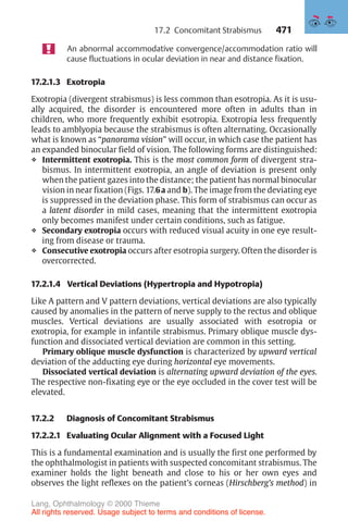 471
An abnormal accommodative convergence/accommodation ratio will
cause fluctuations in ocular deviation in near and distance fixation.
17.2.1.3 Exotropia
Exotropia (divergent strabismus) is less common than esotropia. As it is usu-
ally acquired, the disorder is encountered more often in adults than in
children, who more frequently exhibit esotropia. Exotropia less frequently
leads to amblyopia because the strabismus is often alternating. Occasionally
what is known as “panorama vision” will occur, in which case the patient has
an expanded binocular field of vision. The following forms are distinguished:
❖ Intermittent exotropia. This is the most common form of divergent stra-
bismus. In intermittent exotropia, an angle of deviation is present only
when the patient gazes into the distance; the patient has normal binocular
vision in near fixation (Figs. 17.6a and b). The image from the deviating eye
is suppressed in the deviation phase. This form of strabismus can occur as
a latent disorder in mild cases, meaning that the intermittent exotropia
only becomes manifest under certain conditions, such as fatigue.
❖ Secondary exotropia occurs with reduced visual acuity in one eye result-
ing from disease or trauma.
❖ Consecutive exotropia occurs after esotropia surgery. Often the disorder is
overcorrected.
17.2.1.4 Vertical Deviations (Hypertropia and Hypotropia)
Like A pattern and V pattern deviations, vertical deviations are also typically
caused by anomalies in the pattern of nerve supply to the rectus and oblique
muscles. Vertical deviations are usually associated with esotropia or
exotropia, for example in infantile strabismus. Primary oblique muscle dys-
function and dissociated vertical deviation are common in this setting.
Primary oblique muscle dysfunction is characterized by upward vertical
deviation of the adducting eye during horizontal eye movements.
Dissociated vertical deviation is alternating upward deviation of the eyes.
The respective non-fixating eye or the eye occluded in the cover test will be
elevated.
17.2.2 Diagnosis of Concomitant Strabismus
17.2.2.1 Evaluating Ocular Alignment with a Focused Light
This is a fundamental examination and is usually the first one performed by
the ophthalmologist in patients with suspected concomitant strabismus. The
examiner holds the light beneath and close to his or her own eyes and
observes the light reflexes on the patient’s corneas (Hirschberg’s method) in
17.2 Concomitant Strabismus
Lang, Ophthalmology © 2000 Thieme
All rights reserved. Usage subject to terms and conditions of license.
 