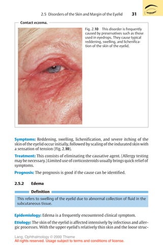 31
Symptoms: Reddening, swelling, lichenification, and severe itching of the
skin of the eyelid occur initially, followed by scaling of the indurated skin with
a sensation of tension (Fig. 2.10).
Treatment: This consists of eliminating the causative agent. (Allergy testing
may be necessary.) Limited use of corticosteroids usually brings quick relief of
symptoms.
Prognosis: The prognosis is good if the cause can be identified.
2.5.2 Edema
Definition
This refers to swelling of the eyelid due to abnormal collection of fluid in the
subcutaneous tissue.
Epidemiology: Edema is a frequently encountered clinical symptom.
Etiology: The skin of the eyelid is affected intensively by infectious and aller-
gic processes. With the upper eyelid’s relatively thin skin and the loose struc-
Contact eczema.
Fig. 2.10 This disorder is frequently
caused by preservatives such as those
used in eyedrops. They cause typical
reddening, swelling, and lichenifica-
tion of the skin of the eyelid.
2.5 Disorders of the Skin and Margin of the Eyelid
Lang, Ophthalmology © 2000 Thieme
All rights reserved. Usage subject to terms and conditions of license.
 