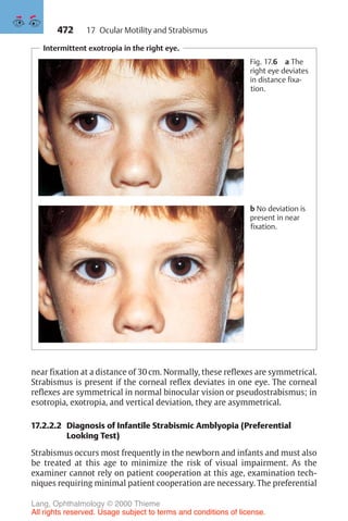 472
Intermittent exotropia in the right eye.
Fig. 17.6 a The
right eye deviates
in distance fixa-
tion.
b No deviation is
present in near
fixation.
near fixation at a distance of 30 cm. Normally, these reflexes are symmetrical.
Strabismus is present if the corneal reflex deviates in one eye. The corneal
reflexes are symmetrical in normal binocular vision or pseudostrabismus; in
esotropia, exotropia, and vertical deviation, they are asymmetrical.
17.2.2.2 Diagnosis of Infantile Strabismic Amblyopia (Preferential
Looking Test)
Strabismus occurs most frequently in the newborn and infants and must also
be treated at this age to minimize the risk of visual impairment. As the
examiner cannot rely on patient cooperation at this age, examination tech-
niques requiring minimal patient cooperation are necessary. The preferential
17 Ocular Motility and Strabismus
Lang, Ophthalmology © 2000 Thieme
All rights reserved. Usage subject to terms and conditions of license.
 