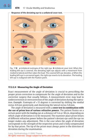 474
Response of the deviating eye to a unilateral cover test.
a
b
c
Fig. 17.8 a Unilateral esotropia of the right eye. b Unilateral cover test: When the
leading left eye is covered, the deviating right eye adjusts with a movement from
medial to lateral and then takes the lead. The covered left eye deviates. c When the
leading left eye is uncovered again, the right eye reverts to its deviation. The leading
left eye is realigned with the fixation point.
17.2.2.4 Measuring the Angle of Deviation
Exact measurement of the angle of deviation is crucial to prescribing the
proper prism correction to compensate for the angle of deviation and to the
corrective surgery that usually follows. A measurement error may lead to
undercorrection or overcorrection of the angle of deviation during the opera-
tion. Example: Esotropia of + 15 degrees is corrected by shifting the medial
rectus 4.0 mm posteriorly and shortening the lateral rectus 5.0 mm.
The angle of deviation is measured with a cover test in combination with
the use of prism lens of various refractive powers. The patient fixates on a
certain point with the leading eye at a distance of 5 m or 30 cm, depending on
which angle of deviation is to be measured. The examiner place prism lenses
of different refractive power before the patient’s deviant eye until the eye no
longer makes any adjustment. This is the case when the angle of deviation
corresponds to the strength of the respective prism and is fully compensated
for by that prism. The tip of the prism must always point in the direction of
deviation during the examination.
17 Ocular Motility and Strabismus
Lang, Ophthalmology © 2000 Thieme
All rights reserved. Usage subject to terms and conditions of license.
 