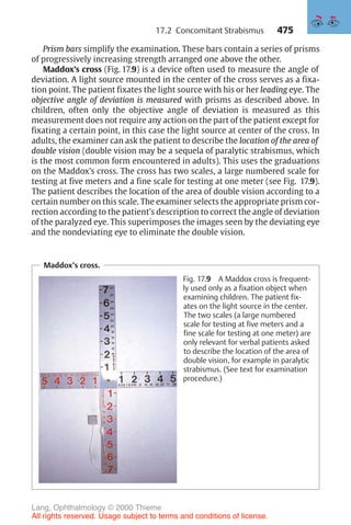 475
Prism bars simplify the examination. These bars contain a series of prisms
of progressively increasing strength arranged one above the other.
Maddox’s cross (Fig. 17.9) is a device often used to measure the angle of
deviation. A light source mounted in the center of the cross serves as a fixa-
tion point. The patient fixates the light source with his or her leading eye. The
objective angle of deviation is measured with prisms as described above. In
children, often only the objective angle of deviation is measured as this
measurement does not require any action on the part of the patient except for
fixating a certain point, in this case the light source at center of the cross. In
adults, the examiner can ask the patient to describe the location of the area of
double vision (double vision may be a sequela of paralytic strabismus, which
is the most common form encountered in adults). This uses the graduations
on the Maddox’s cross. The cross has two scales, a large numbered scale for
testing at five meters and a fine scale for testing at one meter (see Fig. 17.9).
The patient describes the location of the area of double vision according to a
certain number on this scale. The examiner selects the appropriate prism cor-
rection according to the patient’s description to correct the angle of deviation
of the paralyzed eye. This superimposes the images seen by the deviating eye
and the nondeviating eye to eliminate the double vision.
Maddox’s cross.
Fig. 17.9 A Maddox cross is frequent-
ly used only as a fixation object when
examining children. The patient fix-
ates on the light source in the center.
The two scales (a large numbered
scale for testing at five meters and a
fine scale for testing at one meter) are
only relevant for verbal patients asked
to describe the location of the area of
double vision, for example in paralytic
strabismus. (See text for examination
procedure.)
17.2 Concomitant Strabismus
Lang, Ophthalmology © 2000 Thieme
All rights reserved. Usage subject to terms and conditions of license.
 