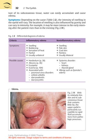 32
ture of its subcutaneous tissue, water can easily accumulate and cause
edema.
Symptoms: Depending on the cause (Table 2.2), the intensity of swelling in
the eyelid will vary. The location of swelling is also influenced by gravity and
can vary in intensity. For example, it may be more intense in the early morn-
ing after the patient rises than in the evening (Fig. 2.11).
Fig. 2.2 Differential diagnosis of edema
Criteria Inflammatory edema Noninflammatory edema
Symptoms ❖ Swelling
❖ Reddening
❖ Sensation of heat
❖ Painful
❖ Usually unilateral
❖ Swelling
❖ Pale skin
❖ Cool skin
❖ Painless
❖ Usually bilateral
Possible causes ❖ Hordeolum (p. 38)
❖ Abscess (p. 36)
❖ Erysipelas
❖ Eczema (p. 104)
❖ Associated with:
– paranasal sinus disorders
– orbital cellulitis
– dacryoadenitis
– dacryocystitis
❖ Systemic disorder:
– heart
– kidneys
– thyroid gland
❖ Allergy such as Quincke’s
edema
Edema.
Fig. 2.11 With
its relatively thin
skin and its sub-
cutaneous tissue
that contains
little fat, the
upper eyelid is
particularly sus-
ceptible to rapid
fluid accumula-
tions from patho-
logic processes.
2 The Eyelids
Lang, Ophthalmology © 2000 Thieme
All rights reserved. Usage subject to terms and conditions of license.
 