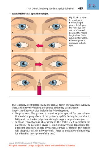 485
Right internuclear ophthalmoplegia.
a
b
c
d
Fig. 17.13 a Paral-
lel visual axes.
b Normal right
gaze. c In left gaze,
the right eye can-
not be adducted
because the medial
longitudinal fasci-
culus is interrupted.
d Convergence is
preserved in both
eyes.
that is clearly attributable to any one cranial nerve. The weakness typically
increases in severity during the course of the day with fatigue.
Important diagnostic aids include the following tests.
– Simpson test: The patient is asked to gaze upward for one minute.
Gradual drooping of one of the patient’s eyelids during the test due to
fatigue of the levator palpebrae strongly suggests myasthenia gravis.
– Tensilon (edrophonium chloride) test: This test is used to confirm the
diagnosis. The patient is given 1–5 mg of intravenous Tensilon (edro-
phonium chloride). Where myasthenia gravis is present, the paresis
will disappear within a few seconds. (Refer to a textbook of neurology
for a detailed description of this test.)
17.5 Ophthalmoplegia and Paralytic Strabismus
Lang, Ophthalmology © 2000 Thieme
All rights reserved. Usage subject to terms and conditions of license.
 