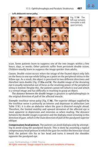 487
Left abducent nerve palsy.
Fig. 17.14 The
left eye remains
immobile in left
gaze (arrow).
ician. Some patients learn to suppress one of the two images within a few
hours, days, or weeks. Other patients suffer from persistent double vision.
Children usually learn to suppress the image quicker than adults.
Causes. Double vision occurs when the image of the fixated object only falls
on the fovea in one eye while falling on a point on the peripheral retina in the
fellow eye. As a result, the object is perceived in two different directions and
therefore seen double (Fig. 17.15a and b). The double image of the deviating
eye is usually somewhat out of focus as the resolving power of the peripheral
retina is limited. Despite this, the patient cannot tell which is real and which
is a virtual image and has difficulty in reaching to grasp an object.
The distance between the double images is greatest in ophthalmoplegia in
the original direction of pull of the affected muscle.
Example: trochlear nerve palsy (Fig. 17.16). The superior oblique supplied by
the trochlear nerve is primarily an intorter and depressor in adduction (see
Table 17.1); it is also an abductor when the gaze is directed straight ahead.
Therefore, the limited motility and upward deviation of the affected eye is
most apparent in depression and intorsion as when reading. The distance
between the double images is greatest and the diplopia most irritating in this
direction of gaze, which is the main direction of pull of the paralyzed superior
oblique.
Compensatory head posture. The patient can avoid diplopia only by attempt-
ing to avoid using the paralyzed muscle. This is done by assuming a typical
compensatory head posture in which the gaze lies within the binocular visual
field; the patient tilts his or her head and turns it toward the shoulder
opposite the paralyzed eye.
17.5 Ophthalmoplegia and Paralytic Strabismus
Lang, Ophthalmology © 2000 Thieme
All rights reserved. Usage subject to terms and conditions of license.
 