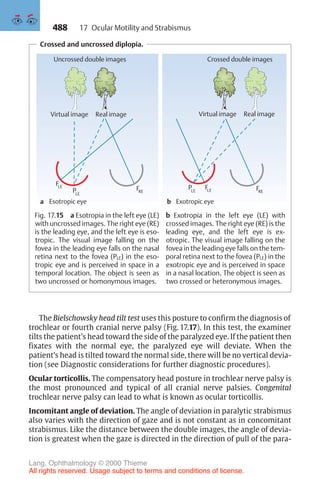 488
Crossed and uncrossed diplopia.
a
LE
P
LE
F
Uncrossed double images
Esotropic eye b Exotropic eye
RE
F
LE
P LE
F
Crossed double images
Virtual image Real image
RE
F
Virtual image Real image
Fig. 17.15 a Esotropia in the left eye (LE)
with uncrossed images. The right eye (RE)
is the leading eye, and the left eye is eso-
tropic. The visual image falling on the
fovea in the leading eye falls on the nasal
retina next to the fovea (PLE) in the eso-
tropic eye and is perceived in space in a
temporal location. The object is seen as
two uncrossed or homonymous images.
b Exotropia in the left eye (LE) with
crossed images. The right eye (RE) is the
leading eye, and the left eye is ex-
otropic. The visual image falling on the
fovea in the leading eye falls on the tem-
poral retina next to the fovea (PLE) in the
exotropic eye and is perceived in space
in a nasal location. The object is seen as
two crossed or heteronymous images.
The Bielschowsky head tilt test uses this posture to confirm the diagnosis of
trochlear or fourth cranial nerve palsy (Fig. 17.17). In this test, the examiner
tilts the patient’s head toward the side of the paralyzed eye. If the patient then
fixates with the normal eye, the paralyzed eye will deviate. When the
patient’s head is tilted toward the normal side, there will be no vertical devia-
tion (see Diagnostic considerations for further diagnostic procedures).
Ocular torticollis. The compensatory head posture in trochlear nerve palsy is
the most pronounced and typical of all cranial nerve palsies. Congenital
trochlear nerve palsy can lead to what is known as ocular torticollis.
Incomitant angle of deviation. The angle of deviation in paralytic strabismus
also varies with the direction of gaze and is not constant as in concomitant
strabismus. Like the distance between the double images, the angle of devia-
tion is greatest when the gaze is directed in the direction of pull of the para-
17 Ocular Motility and Strabismus
Lang, Ophthalmology © 2000 Thieme
All rights reserved. Usage subject to terms and conditions of license.
 
