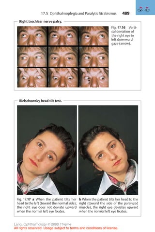 489
Right trochlear nerve palsy.
Fig. 17.16 Verti-
cal deviation of
the right eye in
left downward
gaze (arrow).
Bielschowsky head tilt test.
Fig. 17.17 a When the patient tilts her
head to the left (toward the normal side),
the right eye does not deviate upward
when the normal left eye fixates.
b When the patient tilts her head to the
right (toward the side of the paralyzed
muscle), the right eye deviates upward
when the normal left eye fixates.
17.5 Ophthalmoplegia and Paralytic Strabismus
Lang, Ophthalmology © 2000 Thieme
All rights reserved. Usage subject to terms and conditions of license.
 