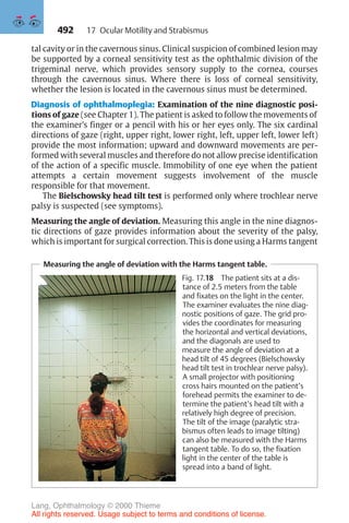 492
tal cavity or in the cavernous sinus. Clinical suspicion of combined lesion may
be supported by a corneal sensitivity test as the ophthalmic division of the
trigeminal nerve, which provides sensory supply to the cornea, courses
through the cavernous sinus. Where there is loss of corneal sensitivity,
whether the lesion is located in the cavernous sinus must be determined.
Diagnosis of ophthalmoplegia: Examination of the nine diagnostic posi-
tions of gaze (see Chapter 1). The patient is asked to follow the movements of
the examiner’s finger or a pencil with his or her eyes only. The six cardinal
directions of gaze (right, upper right, lower right, left, upper left, lower left)
provide the most information; upward and downward movements are per-
formed with several muscles and therefore do not allow precise identification
of the action of a specific muscle. Immobility of one eye when the patient
attempts a certain movement suggests involvement of the muscle
responsible for that movement.
The Bielschowsky head tilt test is performed only where trochlear nerve
palsy is suspected (see symptoms).
Measuring the angle of deviation. Measuring this angle in the nine diagnos-
tic directions of gaze provides information about the severity of the palsy,
which is important for surgical correction. This is done using a Harms tangent
Measuring the angle of deviation with the Harms tangent table.
Fig. 17.18 The patient sits at a dis-
tance of 2.5 meters from the table
and fixates on the light in the center.
The examiner evaluates the nine diag-
nostic positions of gaze. The grid pro-
vides the coordinates for measuring
the horizontal and vertical deviations,
and the diagonals are used to
measure the angle of deviation at a
head tilt of 45 degrees (Bielschowsky
head tilt test in trochlear nerve palsy).
A small projector with positioning
cross hairs mounted on the patient’s
forehead permits the examiner to de-
termine the patient’s head tilt with a
relatively high degree of precision.
The tilt of the image (paralytic stra-
bismus often leads to image tilting)
can also be measured with the Harms
tangent table. To do so, the fixation
light in the center of the table is
spread into a band of light.
17 Ocular Motility and Strabismus
Lang, Ophthalmology © 2000 Thieme
All rights reserved. Usage subject to terms and conditions of license.
 