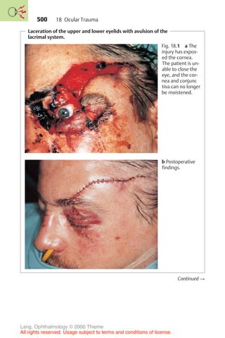500
Laceration of the upper and lower eyelids with avulsion of the
lacrimal system.
Fig. 18.1 a The
injury has expos-
ed the cornea.
The patient is un-
able to close the
eye, and the cor-
nea and conjunc
tiva can no longer
be moistened.
b Postoperative
findings.
Continued !
18 Ocular Trauma
Lang, Ophthalmology © 2000 Thieme
All rights reserved. Usage subject to terms and conditions of license.
 