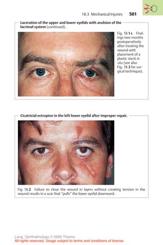 501
Laceration of the upper and lower eyelids with avulsion of the
lacrimal system (continued).
Fig. 18.1c Find-
ings two months
postoperatively
after treating the
wound with
placement of a
plastic stent in
situ (see also
Fig. 18.3 for sur-
gical technique).
Cicatricial ectropion in the left lower eyelid after improper repair.
Fig. 18.2 Failure to close the wound in layers without creating tension in the
wound results in a scar that “pulls” the lower eyelid downward.
18.3 Mechanical Injuries
Lang, Ophthalmology © 2000 Thieme
All rights reserved. Usage subject to terms and conditions of license.
 