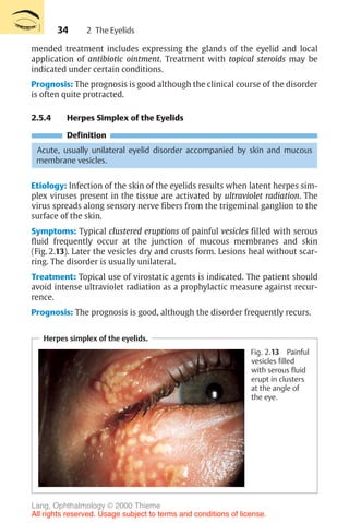 34
mended treatment includes expressing the glands of the eyelid and local
application of antibiotic ointment. Treatment with topical steroids may be
indicated under certain conditions.
Prognosis: The prognosis is good although the clinical course of the disorder
is often quite protracted.
2.5.4 Herpes Simplex of the Eyelids
Definition
Acute, usually unilateral eyelid disorder accompanied by skin and mucous
membrane vesicles.
Etiology: Infection of the skin of the eyelids results when latent herpes sim-
plex viruses present in the tissue are activated by ultraviolet radiation. The
virus spreads along sensory nerve fibers from the trigeminal ganglion to the
surface of the skin.
Symptoms: Typical clustered eruptions of painful vesicles filled with serous
fluid frequently occur at the junction of mucous membranes and skin
(Fig. 2.13). Later the vesicles dry and crusts form. Lesions heal without scar-
ring. The disorder is usually unilateral.
Treatment: Topical use of virostatic agents is indicated. The patient should
avoid intense ultraviolet radiation as a prophylactic measure against recur-
rence.
Prognosis: The prognosis is good, although the disorder frequently recurs.
Herpes simplex of the eyelids.
Fig. 2.13 Painful
vesicles filled
with serous fluid
erupt in clusters
at the angle of
the eye.
2 The Eyelids
Lang, Ophthalmology © 2000 Thieme
All rights reserved. Usage subject to terms and conditions of license.
 