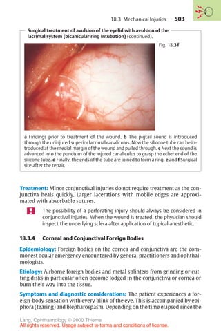 503
Treatment: Minor conjunctival injuries do not require treatment as the con-
junctiva heals quickly. Larger lacerations with mobile edges are approxi-
mated with absorbable sutures.
The possibility of a perforating injury should always be considered in
conjunctival injuries. When the wound is treated, the physician should
inspect the underlying sclera after application of topical anesthetic.
18.3.4 Corneal and Conjunctival Foreign Bodies
Epidemiology: Foreign bodies on the cornea and conjunctiva are the com-
monest ocular emergency encountered by general practitioners and ophthal-
mologists.
Etiology: Airborne foreign bodies and metal splinters from grinding or cut-
ting disks in particular often become lodged in the conjunctiva or cornea or
burn their way into the tissue.
Symptoms and diagnostic considerations: The patient experiences a for-
eign-body sensation with every blink of the eye. This is accompanied by epi-
phora (tearing) and blepharospasm. Depending on the time elapsed since the
Surgical treatment of avulsion of the eyelid with avulsion of the
lacrimal system (bicanicular ring intubation) (continued).
Fig. 18.3f
a Findings prior to treatment of the wound. b The pigtail sound is introduced
through the uninjured superior lacrimal canaliculus. Now the silicone tube can be in-
troduced at the medial margin of the wound and pulled through. c Next the sound is
advanced into the punctum of the injured canaliculus to grasp the other end of the
silicone tube. d Finally, the ends of the tube are joined to form a ring. e and f Surgical
site after the repair.
18.3 Mechanical Injuries
Lang, Ophthalmology © 2000 Thieme
All rights reserved. Usage subject to terms and conditions of license.
 