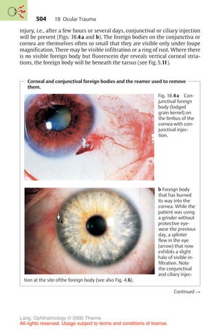 504
injury, i.e., after a few hours or several days, conjunctival or ciliary injection
will be present (Figs. 18.4a and b). The foreign bodies on the conjunctiva or
cornea are themselves often so small that they are visible only under loupe
magnification. There may be visible infiltration or a ring of rust. Where there
is no visible foreign body but fluorescein dye reveals vertical corneal stria-
tions, the foreign body will be beneath the tarsus (see Fig. 5.11).
Corneal and conjunctival foreign bodies and the reamer used to remove
them.
Fig. 18.4a Con-
junctival foreign
body (lodged
grain kernel) on
the limbus of the
cornea with con-
junctival injec-
tion.
b Foreign body
that has burned
its way into the
cornea. While the
patient was using
a grinder without
protective eye-
wear the previous
day, a splinter
flew in the eye
(arrow) that now
exhibits a slight
halo of visible in-
filtration. Note
the conjunctival
and ciliary injec-
tion at the site ofthe foreign body (see also Fig. 4.6).
Continued !
18 Ocular Trauma
Lang, Ophthalmology © 2000 Thieme
All rights reserved. Usage subject to terms and conditions of license.
 