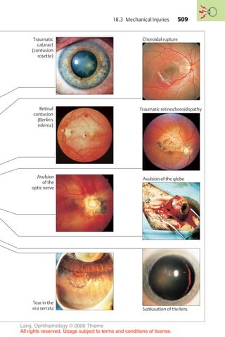 509
Traumatic
cataract
(contusion
rosette)
Choroidal rupture
Retinal
contusion
(Berlin's
edema)
Traumatic retinochoroidopathy
Avulsion
of the
optic nerve
Tear in the
ora serrata Subluxation of the lens
Avulsion of the globe
18.3 Mechanical Injuries
Lang, Ophthalmology © 2000 Thieme
All rights reserved. Usage subject to terms and conditions of license.
 
