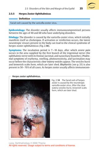 35
2.5.5 Herpes Zoster Ophthalmicus
Definition
Facial rash caused by the varicella-zoster virus.
Epidemiology: The disorder usually affects immunocompromised persons
between the ages of 40 and 60 who have underlying disorders.
Etiology: The disorder is caused by the varicella-zoster virus, which initially
manifests itself as chickenpox. If activation or reinfection occurs, the latent
neurotropic viruses present in the body can lead to the clinical syndrome of
herpes zoster ophthalmicus (Fig. 2.14).
Symptoms: The incubation period is 7–18 days, after which severe pain
occurs in the area supplied by the first branch of the trigeminal nerve (the
ophthalmic nerve with its frontal, lacrimal, and nasociliary branches). Prodro-
mal symptoms of erythema, swelling, photosensitivity, and lacrimation may
occur before the characteristic clear watery vesicles appear. The vesicles burst
and brownish scabs form, which are later shed. Blepharitis (see p. 33) is also
present in 50–70% of all cases. As herpes zoster usually affects immunocom-
Herpes zoster ophthalmicus.
Fig. 2.14 The facial rash of herpes
zoster is caused by the neurotropic
varicella-zoster virus. After the clear
watery vesicles burst, brownish scabs
form, which are later shed.
2.5 Disorders of the Skin and Margin of the Eyelid
Lang, Ophthalmology © 2000 Thieme
All rights reserved. Usage subject to terms and conditions of license.
 