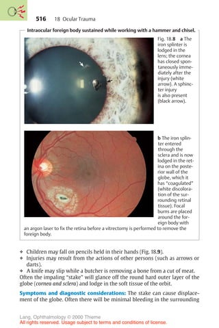 516
Intraocular foreign body sustained while working with a hammer and chisel.
Fig. 18.8 a The
iron splinter is
lodged in the
lens; the cornea
has closed spon-
taneously imme-
diately after the
injury (white
arrow). A sphinc-
ter injury
is also present
(black arrow).
b The iron splin-
ter entered
through the
sclera and is now
lodged in the ret-
ina on the poste-
rior wall of the
globe, which it
has “coagulated”
(white discolora-
tion of the sur-
rounding retinal
tissue). Focal
burns are placed
around the for-
eign body with
an argon laser to fix the retina before a vitrectomy is performed to remove the
foreign body.
❖ Children may fall on pencils held in their hands (Fig. 18.9).
❖ Injuries may result from the actions of other persons (such as arrows or
darts).
❖ A knife may slip while a butcher is removing a bone from a cut of meat.
Often the impaling “stake” will glance off the round hard outer layer of the
globe (cornea and sclera) and lodge in the soft tissue of the orbit.
Symptoms and diagnostic considerations: The stake can cause displace-
ment of the globe. Often there will be minimal bleeding in the surrounding
18 Ocular Trauma
Lang, Ophthalmology © 2000 Thieme
All rights reserved. Usage subject to terms and conditions of license.
 