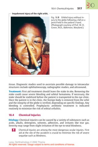 517
Impalement injury of the right orbit.
Fig. 18.9 Orbital injury without in-
jury to the globe following a fall on a
pencil held in the patient’s hand.
(Photograph courtesy of Prof. W. D.
Green, M.D., Baltimore, Maryland.)
tissue. Diagnostic studies used to ascertain possible damage to intraocular
structures include ophthalmoscopy, radiographic studies, and ultrasound.
Treatment: First aid treatment should leave the stake in situ. Removing the
stake could cause severe bleeding and orbital hematoma. If necessary, the
stake should be stabilized before the patient is transported to the eye clinic.
Once the patient is in the clinic, the foreign body is removed from the orbit
and the integrity of the globe is verified, depending on specific findings. Any
bleeding is controlled. Prophylactic antibiotic treatment is indicated
routinely to minimize the risk of orbital cellulitis.
18.4 Chemical Injuries
Etiology: Chemical injuries can be caused by a variety of substances such as
acids, alkalis, detergents, solvents, adhesives, and irritants like tear gas.
Severity may range from slight irritation of the eye to total blindness.
Chemical injuries are among the most dangerous ocular injuries. First
aid at the site of the accident is crucial to minimize the risk of severe
sequelae such as blindness.
18.4 Chemical Injuries
Lang, Ophthalmology © 2000 Thieme
All rights reserved. Usage subject to terms and conditions of license.
 
