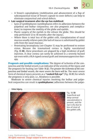 521
– A Tenon’s capsuloplasty (mobilization and advancement of a flap of
subconjunctival tissue of Tenon’s capsule to cover defects) can help to
eliminate conjunctival and scleral defects.
❖ Late surgical treatment after the eye has stabilized:
– Lysis of symblepharon (symblepharon refers to adhesions between the
palpebral and bulbar conjunctiva; see also prognosis and complica-
tions) to improve the motility of the globe and eyelids.
– Plastic surgery of the eyelids to the release the globe. This should be
only performed 12 to 18 months after the injury).
– Where there is total loss of the goblet cells, transplantation of nasal
mucosa usually relieves pain (the lack of mucus is substituted by goblet
cells from the nasal mucosa).
– Penetrating keratoplasty (see Chapter 5) may be performed to restore
vision. Because the traumatized cornea is highly vascularized
(Fig. 18.10), these procedures are plagued by a high incidence of graft
rejection. A clear cornea can rarely be achieved in a severely burned
eye even with a HLA-typed corneal graft and immunosuppressive ther-
apy.
Prognosis and possible complications: The degree of ischemia of the con-
junctiva and the limbal vessels is an indicator of the severity of the injury and
the prognosis for healing (see Table 18.2). The greater the ischemia of the con-
junctiva and limbal vessels, the more severe the burn will be. The most severe
form of chemical injury presents as a “cooked fish eye” (Fig. 18.11) for which
the prognosis is very poor, i.e., blindness is possible.
Moderate to severe chemical injuries involving the bulbar and palpe-
bral conjunctiva can result in symblepharon (adhesions between the palpe-
Lime injury.
Fig. 18.10
Superficial and
deep corneal
vascularization is
present, and the
eye is dry due to
loss of most of
the goblet cells.
18.4 Chemical Injuries
Lang, Ophthalmology © 2000 Thieme
All rights reserved. Usage subject to terms and conditions of license.
 