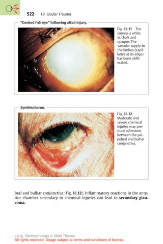 522
“Cooked fish eye” following alkali injury.
Fig. 18.11 The
cornea is white
as chalk and
opaque. The
vascular supply to
the limbus (capil-
laries at its edge)
has been oblit-
erated.
Symblepharon.
Fig. 18.12
Moderate and
severe chemical
injuries may pro-
duce adhesions
between the pal-
pebral and bulbar
conjunctiva.
bral and bulbar conjunctiva; Fig. 18.12). Inflammatory reactions in the ante-
rior chamber secondary to chemical injuries can lead to secondary glau-
coma.
18 Ocular Trauma
Lang, Ophthalmology © 2000 Thieme
All rights reserved. Usage subject to terms and conditions of license.
 