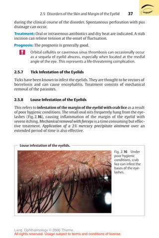 37
during the clinical course of the disorder. Spontaneous perforation with pus
drainage can occur.
Treatment: Oral or intravenous antibiotics and dry heat are indicated. A stab
incision can relieve tension at the onset of fluctuation.
Prognosis: The prognosis is generally good.
Orbital cellulitis or cavernous sinus thrombosis can occasionally occur
as a sequela of eyelid abscess, especially when located at the medial
angle of the eye. This represents a life-threatening complication.
2.5.7 Tick Infestation of the Eyelids
Ticks have been known to infest the eyelids. They are thought to be vectors of
borreliosis and can cause encephalitis. Treatment consists of mechanical
removal of the parasites.
2.5.8 Louse Infestation of the Eyelids
This refers to infestation of the margin of the eyelid with crab lice as a result
of poor hygienic conditions. The small oval nits frequently hang from the eye-
lashes (Fig. 2.16), causing inflammation of the margin of the eyelid with
severe itching. Mechanical removal with forceps is a time consuming but effec-
tive treatment. Application of a 2% mercury precipitate ointment over an
extended period of time is also effective.
Louse infestation of the eyelids.
Fig. 2.16 Under
poor hygienic
conditions, crab
lice can infest the
bases of the eye-
lashes.
2.5 Disorders of the Skin and Margin of the Eyelid
Lang, Ophthalmology © 2000 Thieme
All rights reserved. Usage subject to terms and conditions of license.
 