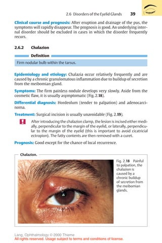 39
Clinical course and prognosis: After eruption and drainage of the pus, the
symptoms will rapidly disappear. The prognosis is good. An underlying inter-
nal disorder should be excluded in cases in which the disorder frequently
recurs.
2.6.2 Chalazion
Definition
Firm nodular bulb within the tarsus.
Epidemiology and etiology: Chalazia occur relatively frequently and are
caused by a chronic granulomatous inflammation due to buildup of secretion
from the meibomian gland.
Symptoms: The firm painless nodule develops very slowly. Aside from the
cosmetic flaw, it is usually asymptomatic (Fig. 2.18).
Differential diagnosis: Hordeolum (tender to palpation) and adenocarci-
noma.
Treatment: Surgical incision is usually unavoidable (Fig. 2.19).
After introducing the chalazion clamp, the lesion is incised either medi-
ally, perpendicular to the margin of the eyelid, or laterally, perpendicu-
lar to the margin of the eyelid (this is important to avoid cicatricial
ectropion). The fatty contents are then removed with a curet.
Prognosis: Good except for the chance of local recurrence.
Chalazion.
Fig. 2.18 Painful
to palpation, the
chalazion is
caused by a
chronic buildup
of secretion from
the meibomian
glands.
2.6 Disorders of the Eyelid Glands
Lang, Ophthalmology © 2000 Thieme
All rights reserved. Usage subject to terms and conditions of license.
 