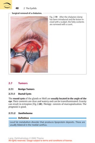 40
Surgical removal of a chalazion.
Fig. 2.19 After the chalazion clamp
has been introduced and the lesion in-
cised with a scalpel, the fatty contents
are removed with a curet.
2.7 Tumors
2.7.1 Benign Tumors
2.7.1.1 Ductal Cysts
The round cysts of the glands or Moll are usually located in the angle of the
eye. Their contents are clear and watery and can be transilluminated. Gravity
can result in ectropion (Fig. 2.20). Therapy consists of marsupialization. The
prognosis is good.
2.7.1.2 Xanthelasma
Definition
Local fat metabolism disorder that produces lipoprotein deposits. These are
usually bilateral in the medial canthus.
2 The Eyelids
Lang, Ophthalmology © 2000 Thieme
All rights reserved. Usage subject to terms and conditions of license.
 