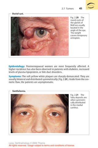 41
Ductal cyst.
Fig. 2.20 The
round cysts of
the glands of
Moll are usually
located in the
angle of the eye.
The weight
causes temporary
ectropion.
Epidemiology: Postmenopausal women are most frequently affected. A
higher incidence has also been observed in patients with diabetes, increased
levels of plasma lipoprotein, or bile duct disorders.
Symptoms: The soft yellow white plaques are sharply demarcated. They are
usually bilateral and distributed symmetrically (Fig. 2.21). Aside from the cos-
metic flaw, the patients are asymptomatic.
Xanthelasma.
Fig. 2.21 The
fatty deposits are
often symmetri-
cally distributed
in the medial
canthus.
2.7 Tumors
Lang, Ophthalmology © 2000 Thieme
All rights reserved. Usage subject to terms and conditions of license.
 
