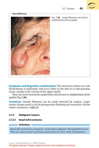 45
Symptoms and diagnostic considerations: The numerous tumors are soft,
broad-based, or pediculate, and occur either in the skin or in subcutaneous
tissue, usually in the vicinity of the upper eyelid.
They can reach monstrous proportions and present as elephantiasis of the
eyelids (Fig. 2.26).
Treatment: Smaller fibromas can be easily removed by surgery. Larger
tumors always entail a risk of postoperative bleeding and recurrence. On the
whole, treatment is difficult.
2.7.2 Malignant Tumors
2.7.2.1 Basal Cell Carcinoma
Definition
Basal cell carcinoma is a frequent, moderately malignant, fibroepithelial tumor
that can cause severe local tissue destruction but very rarely metastasizes.
Neurofibroma.
Fig. 2.26 Larger fibromas can lead to
elephantiasis of the eyelids.
2.7 Tumors
Lang, Ophthalmology © 2000 Thieme
All rights reserved. Usage subject to terms and conditions of license.
 