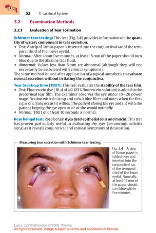 52
Measuring tear secretion with Schirmer tear testing.
Fig. 3.4 A strip
of litmus paper is
folded over and
inserted into the
conjunctival sac
of the temporal
third of the lower
eyelid. Normally,
at least 15 mm of
the paper should
turn blue within
five minutes.
3.2 Examination Methods
3.2.1 Evaluation of Tear Formation
Schirmer tear testing: This test (Fig. 3.4) provides information on the quan-
tity of watery component in tear secretion.
❖ Test: A strip of litmus paper is inserted into the conjunctival sac of the tem-
poral third of the lower eyelid.
❖ Normal: After about five minutes, at least 15 mm of the paper should turn
blue due to the alkaline tear fluid.
❖ Abnormal: Values less than 5 mm are abnormal (although they will not
necessarily be associated with clinical symptoms).
The same method is used after application of a topical anesthetic to evaluate
normal secretion without irritating the conjunctiva.
Tear break-up time (TBUT): This test evaluates the stability of the tear film.
❖ Test: Fluorescein dye (10 µl of a 0.125% fluorescein solution) is added to the
precorneal tear film. The examiner observes the eye under 10–20 power
magnification with slit lamp and cobalt blue filter and notes when the first
signs of drying occur (i) without the patient closing the eye and (ii) with the
patient keeping the eye open as he or she would normally.
❖ Normal: TBUT of at least 10 seconds is normal.
Rose bengal test: Rose bengal dyes dead epithelial cells and mucin. This test
has proven particularly useful in evaluating dry eyes (keratoconjunctivitis
sicca) as it reveals conjunctival and corneal symptoms of desiccation.
3 Lacrimal System
Lang, Ophthalmology © 2000 Thieme
All rights reserved. Usage subject to terms and conditions of license.
 
