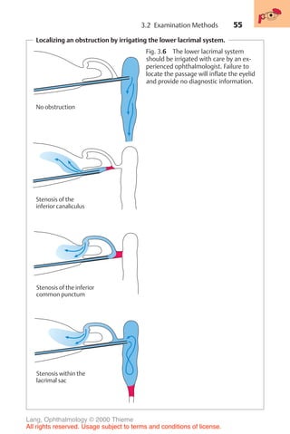 55
Localizing an obstruction by irrigating the lower lacrimal system.
No obstruction
Stenosis of the
inferior canaliculus
Stenosis of the inferior
common punctum
Stenosis within the
lacrimal sac
Fig. 3.6 The lower lacrimal system
should be irrigated with care by an ex-
perienced ophthalmologist. Failure to
locate the passage will inflate the eyelid
and provide no diagnostic information.
3.2 Examination Methods
Lang, Ophthalmology © 2000 Thieme
All rights reserved. Usage subject to terms and conditions of license.
 
