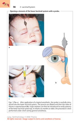 56
Opening a stenosis of the lower lacrimal system with a probe.
Figs. 3.7a–c After application of a topical anesthetic, the probe is carefully intro-
duced into the lower lacrimal system. The puncta are dilated and then the valve of
Hasner is opened (a and b). A dye solution can then be introduced to verify patency
of the lower lacrimal system (c). In infants six months or older, the procedure is best
performed under short-acting general anesthesia.
a
c
b
3 Lacrimal System
Lang, Ophthalmology © 2000 Thieme
All rights reserved. Usage subject to terms and conditions of license.
 
