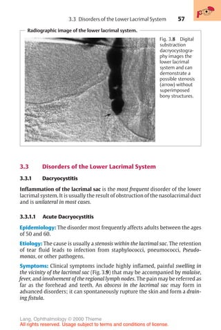 57
Radiographic image of the lower lacrimal system.
Fig. 3.8 Digital
substraction
dacryocystogra-
phy images the
lower lacrimal
system and can
demonstrate a
possible stenosis
(arrow) without
superimposed
bony structures.
3.3 Disorders of the Lower Lacrimal System
3.3.1 Dacryocystitis
Inflammation of the lacrimal sac is the most frequent disorder of the lower
lacrimal system. It is usually the result of obstruction of the nasolacrimal duct
and is unilateral in most cases.
3.3.1.1 Acute Dacryocystitis
Epidemiology: The disorder most frequently affects adults between the ages
of 50 and 60.
Etiology: The cause is usually a stenosis within the lacrimal sac. The retention
of tear fluid leads to infection from staphylococci, pneumococci, Pseudo-
monas, or other pathogens.
Symptoms: Clinical symptoms include highly inflamed, painful swelling in
the vicinity of the lacrimal sac (Fig. 3.9) that may be accompanied by malaise,
fever, and involvement of the regional lymph nodes. The pain may be referred as
far as the forehead and teeth. An abscess in the lacrimal sac may form in
advanced disorders; it can spontaneously rupture the skin and form a drain-
ing fistula.
3.3 Disorders of the Lower Lacrimal System
Lang, Ophthalmology © 2000 Thieme
All rights reserved. Usage subject to terms and conditions of license.
 